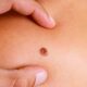 Melanoma e cannabis