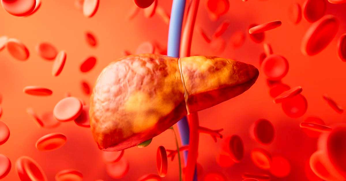 Steatosi epatica e cannabinoidi